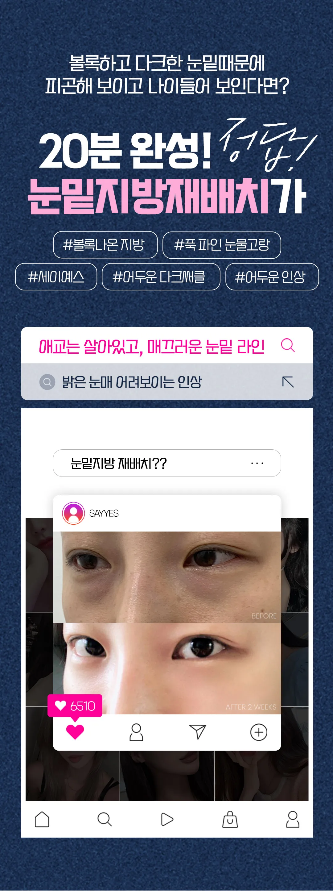 세이예스의원  다크서클, 눈밑지방에 효과 좋은 눈밑지방재배치 이벤트 이벤트, 시술 상세 이미지