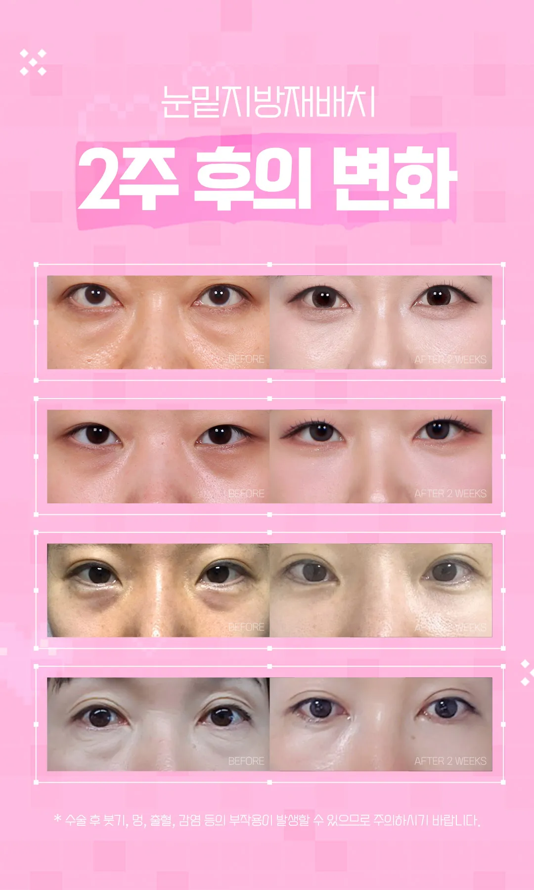 세이예스의원  다크서클, 눈밑지방에 효과 좋은 눈밑지방재배치 이벤트 이벤트, 시술 상세 이미지