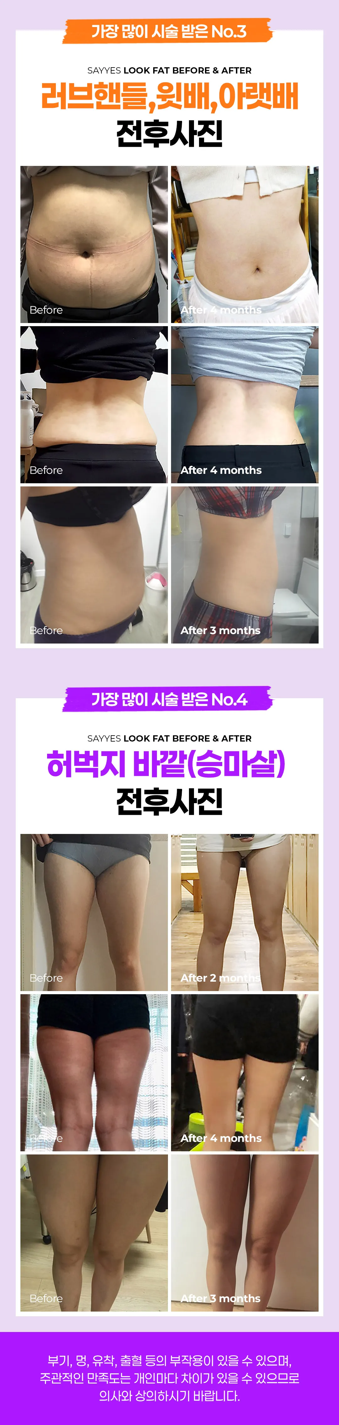 세이예스의원 10분만에 군살 정리! 지방추출주사 룩팻 이벤트 이벤트, 시술 상세 이미지