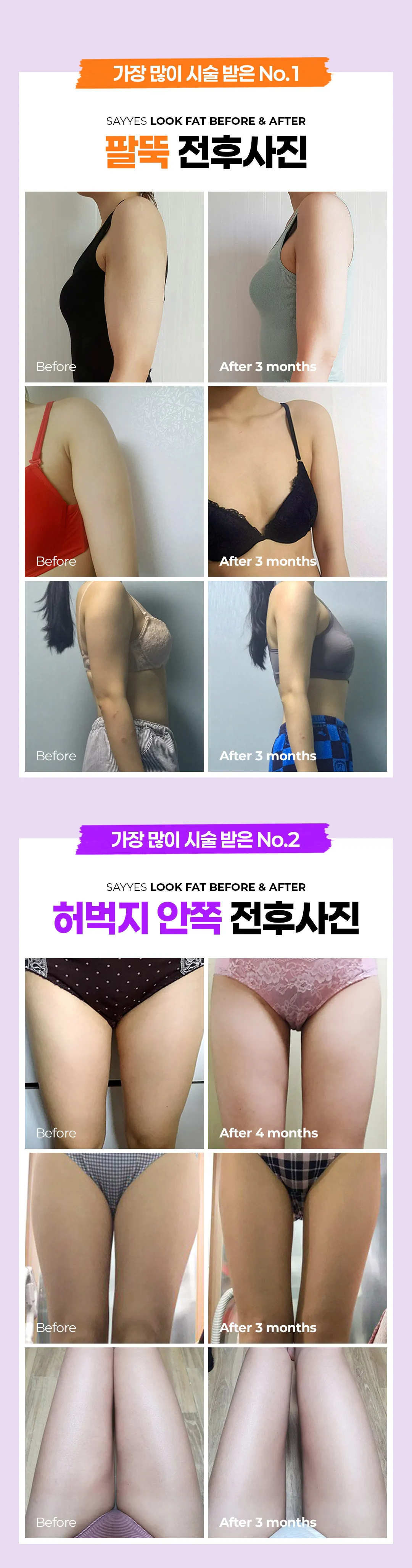세이예스의원 10분만에 군살 정리! 지방추출주사 룩팻 이벤트 이벤트, 시술 상세 이미지