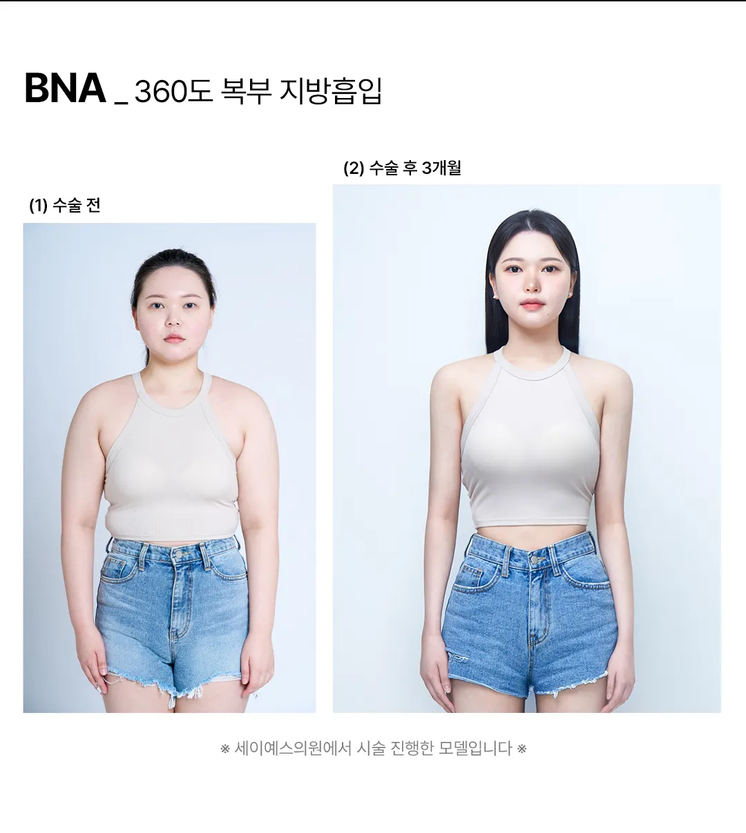 세이예스의원 대용량 복부전체지방흡입, 앞복부+옆구리+러브핸들 흡입 이벤트, 시술 상세 이미지