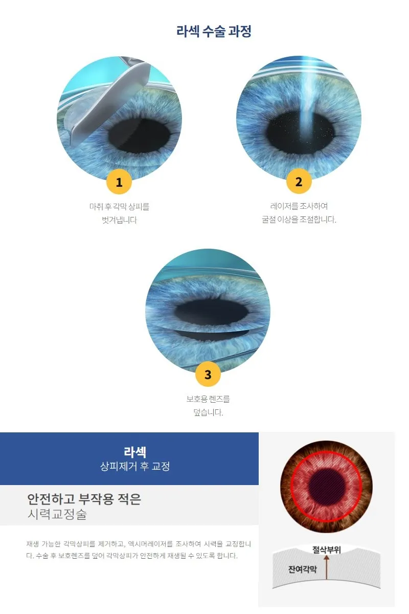 프리미엄 라섹