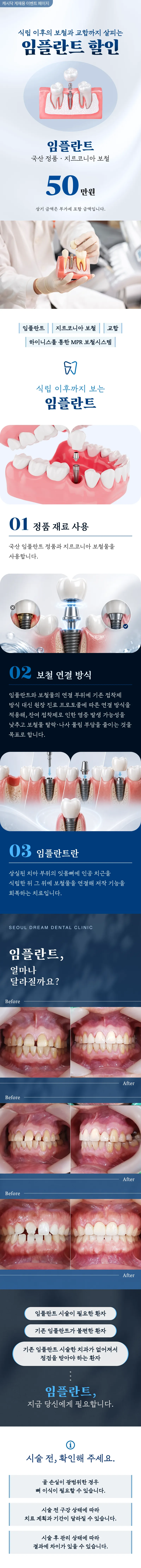 임플란트