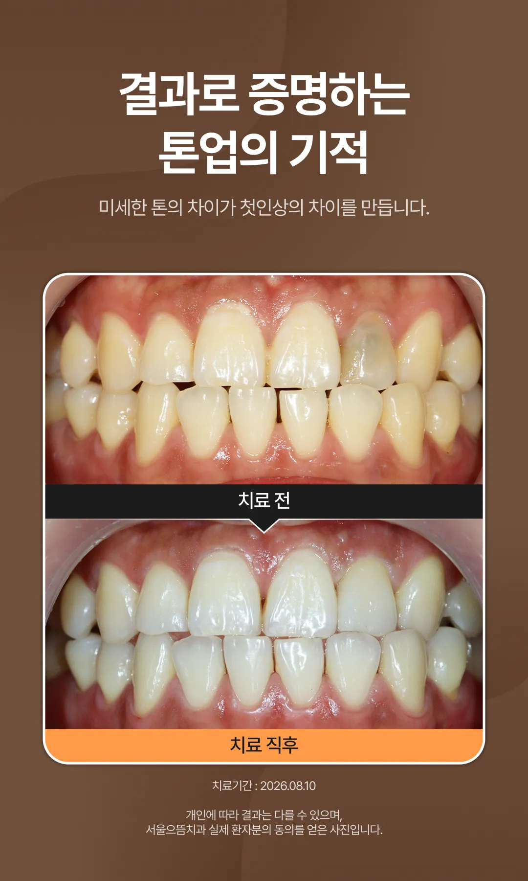 치아미백