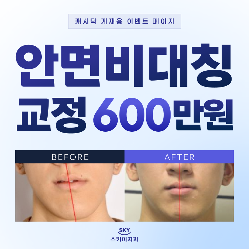 안면비대칭교정 이벤트 썸네일 이미지