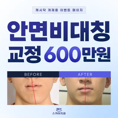 안면비대칭교정 이벤트 썸네일 이미지
