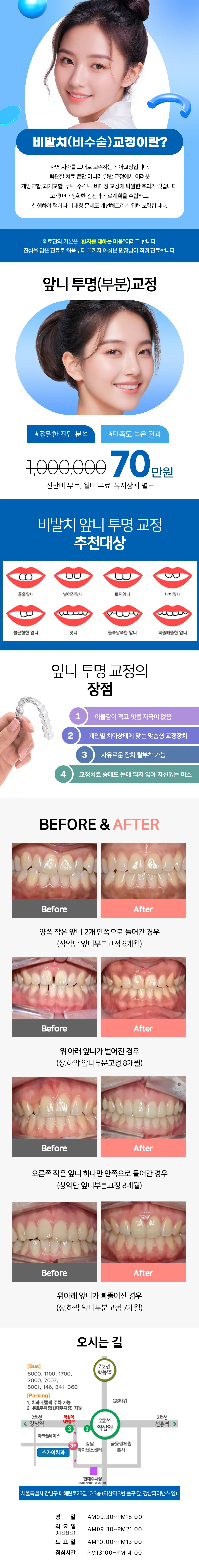 스카이치과의원 [특가] 앞니 투명 (부분) 교정 이벤트, 시술 상세 이미지