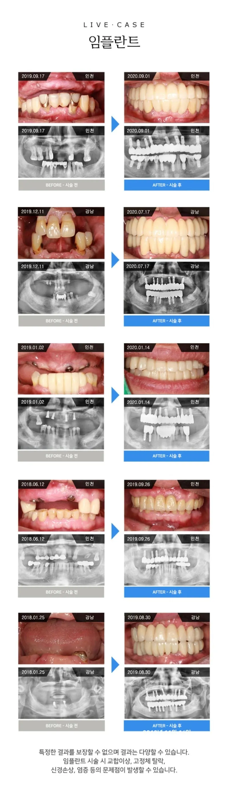 라이브치과병원 서울강남 오스템 전체임플란트!당일식립,주말진료 이벤트, 시술 상세 이미지