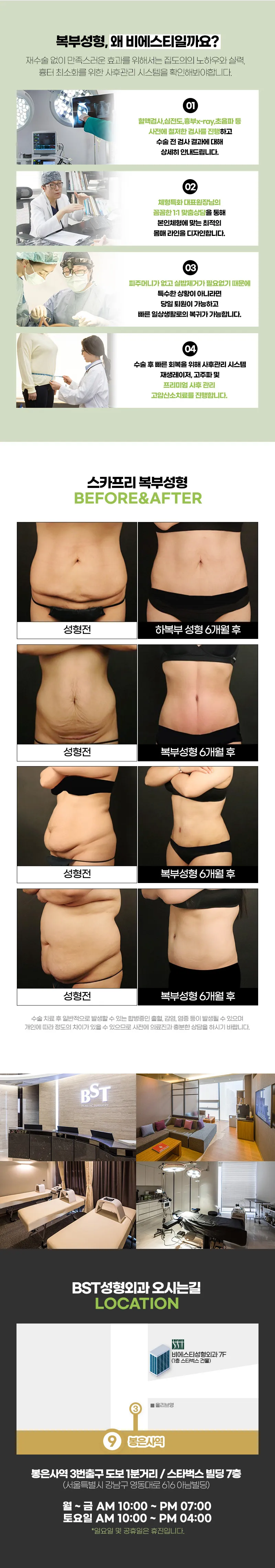 비에스티성형외과 ❤️스카프리 미니복부성형❤️ 이벤트, 시술 상세 이미지