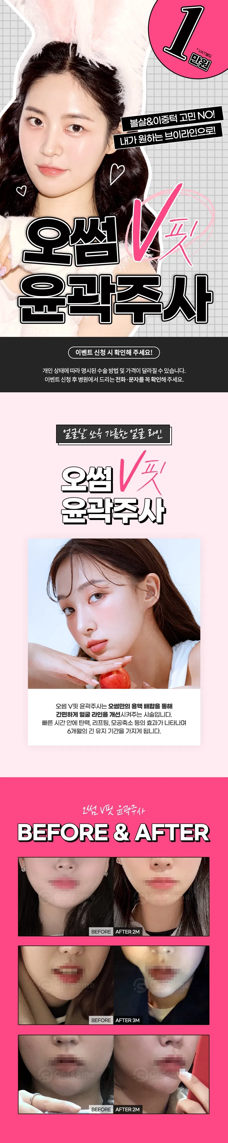 오썸성형외과 강남역 오썸 V핏 윤곽주사 이벤트, 시술 상세 이미지