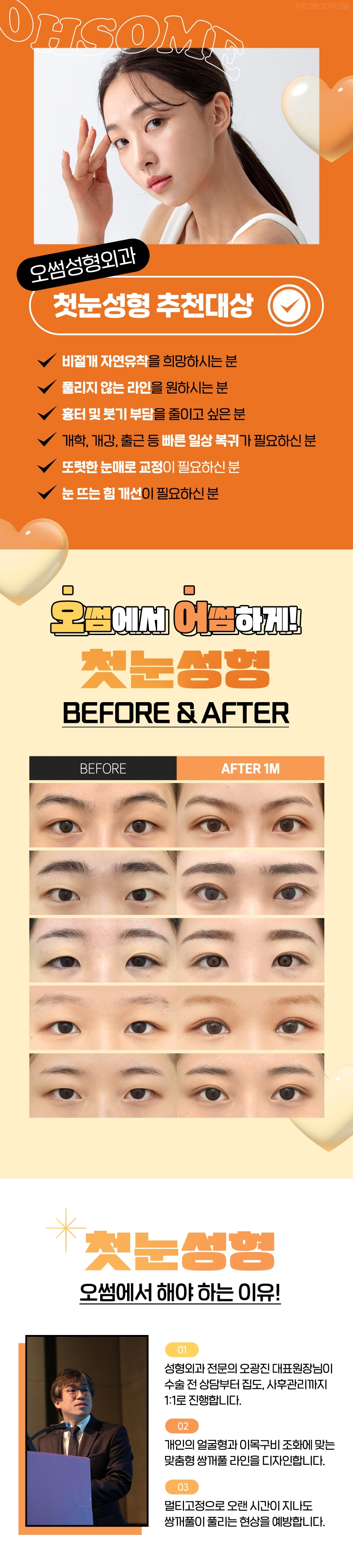 오썸성형외과 강남역 오썸 첫눈성형 이벤트, 시술 상세 이미지