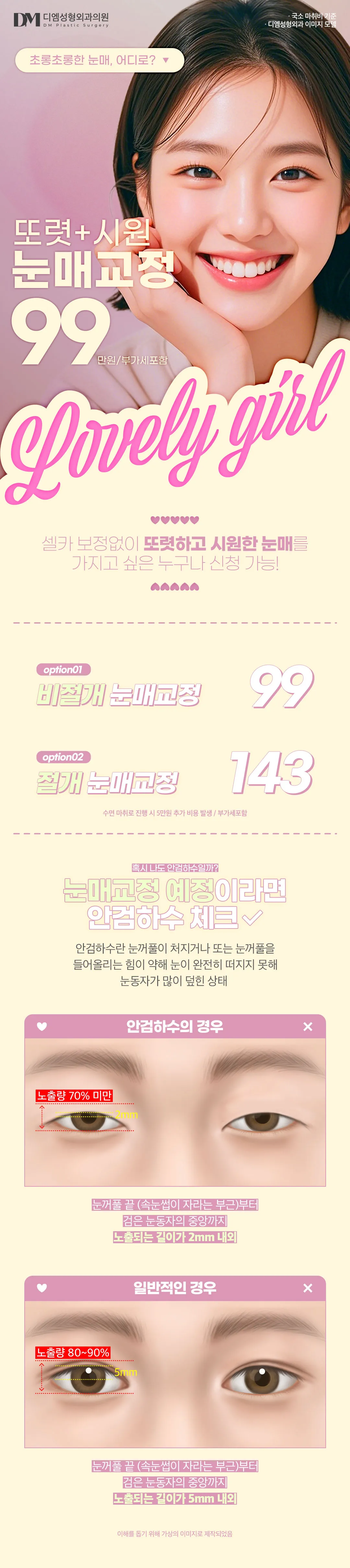 디엠성형외과 ♥디엠 눈매교정♥ 이벤트, 시술 상세 이미지