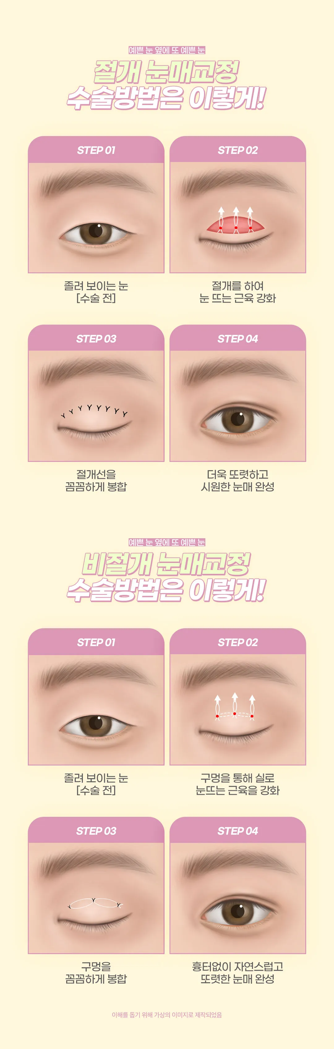 디엠성형외과 ♥디엠 눈매교정♥ 이벤트, 시술 상세 이미지