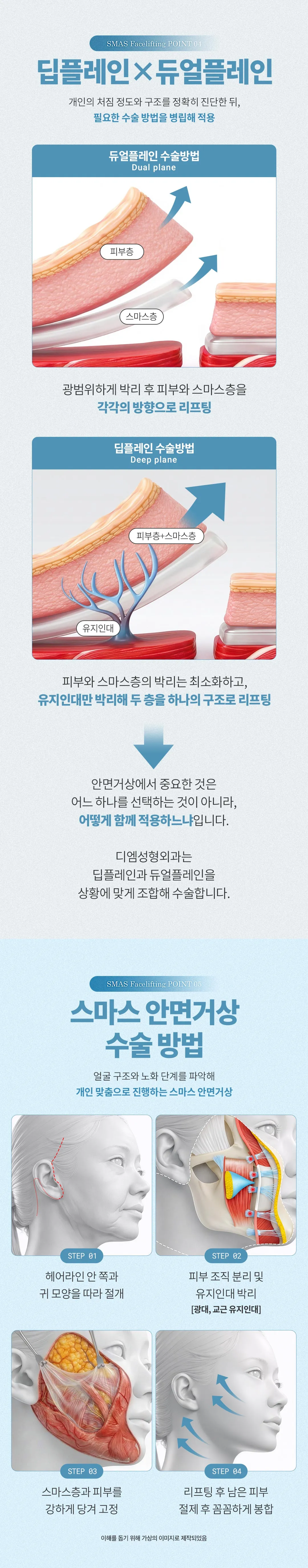디엠성형외과 ♥디엠 스마스 안면거상 ♥ 이벤트, 시술 상세 이미지