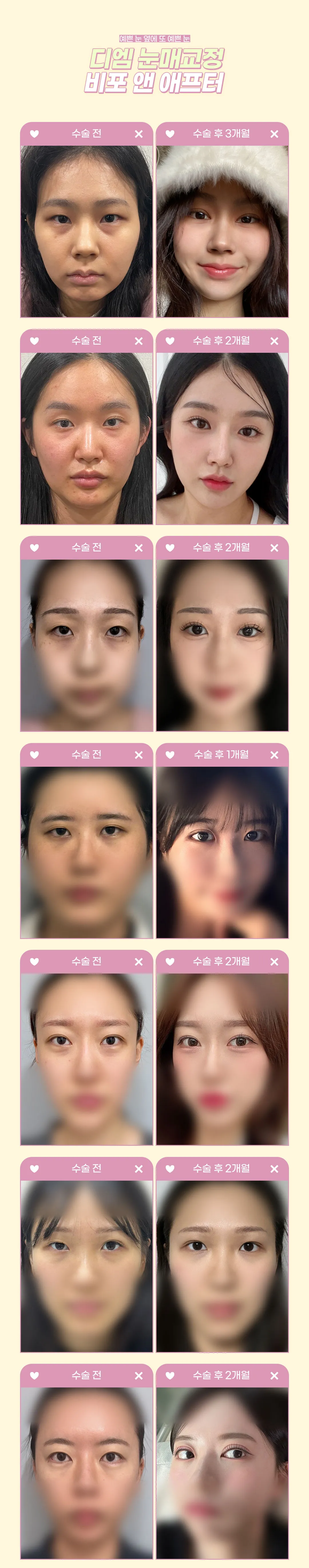 디엠성형외과 ♥디엠 눈매교정♥ 이벤트, 시술 상세 이미지