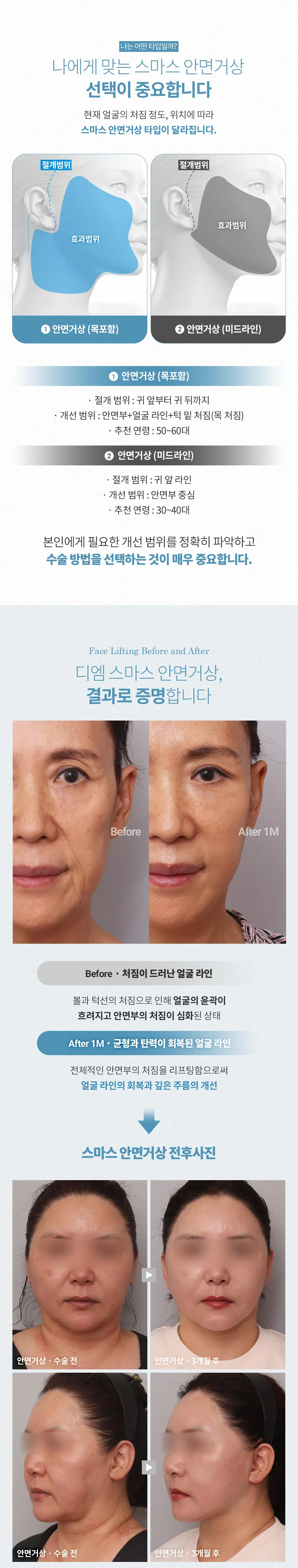 디엠성형외과 ♥디엠 스마스 안면거상 ♥ 이벤트, 시술 상세 이미지