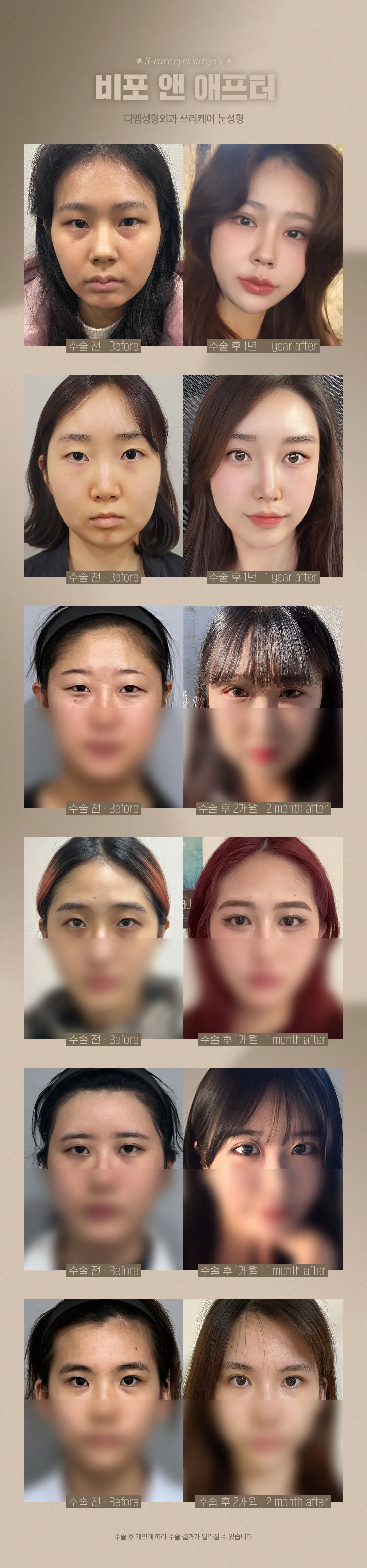 디엠성형외과 디엠 쓰리케어 눈성형 이벤트, 시술 상세 이미지