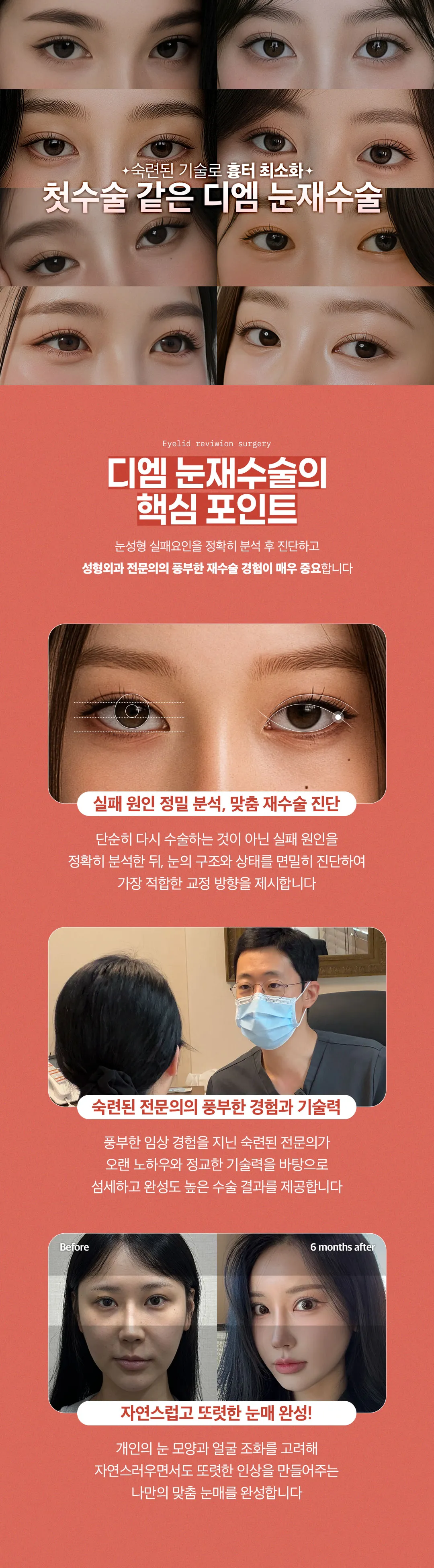 디엠성형외과 ❤디엠❤ 눈재수술 이벤트, 시술 상세 이미지