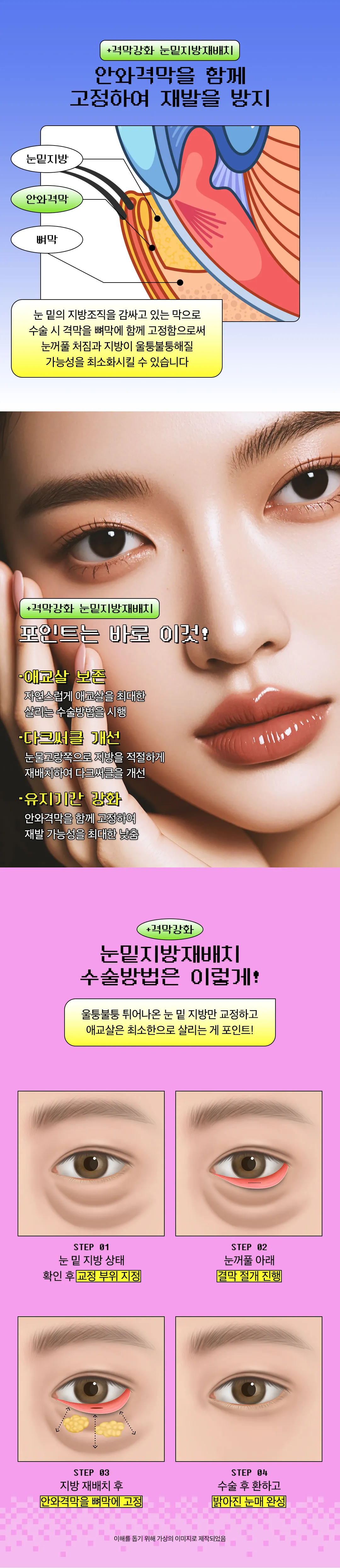 디엠성형외과 격막강화 눈밑지방재배치 이벤트, 시술 상세 이미지