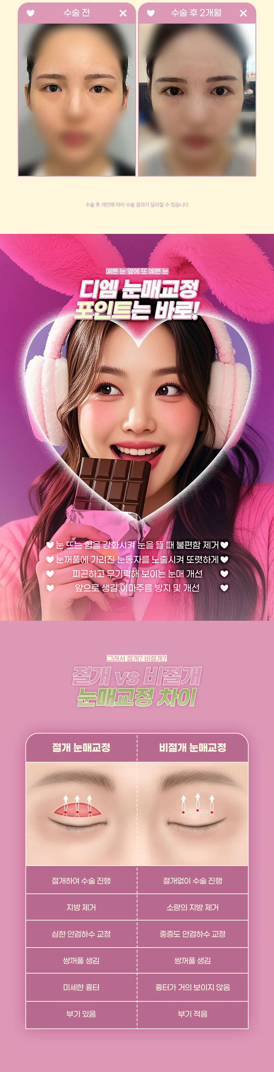 디엠성형외과 ♥디엠 눈매교정♥ 이벤트, 시술 상세 이미지