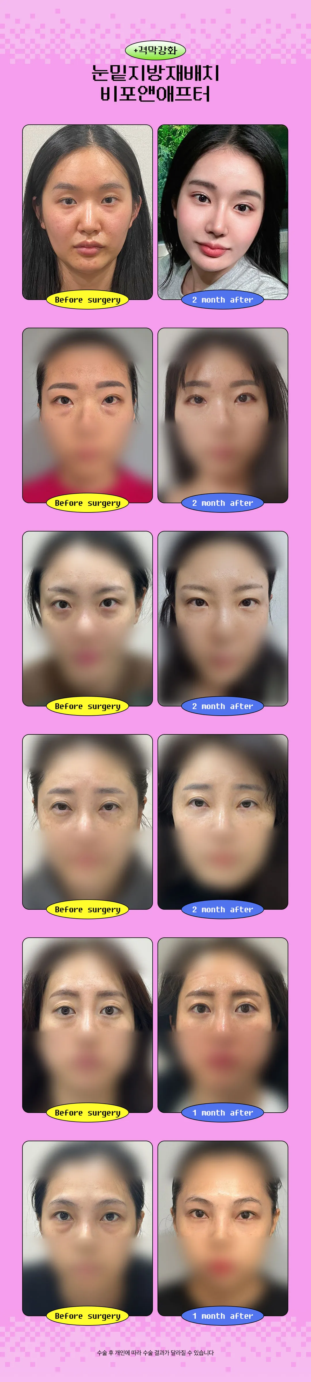 디엠성형외과 격막강화 눈밑지방재배치 이벤트, 시술 상세 이미지