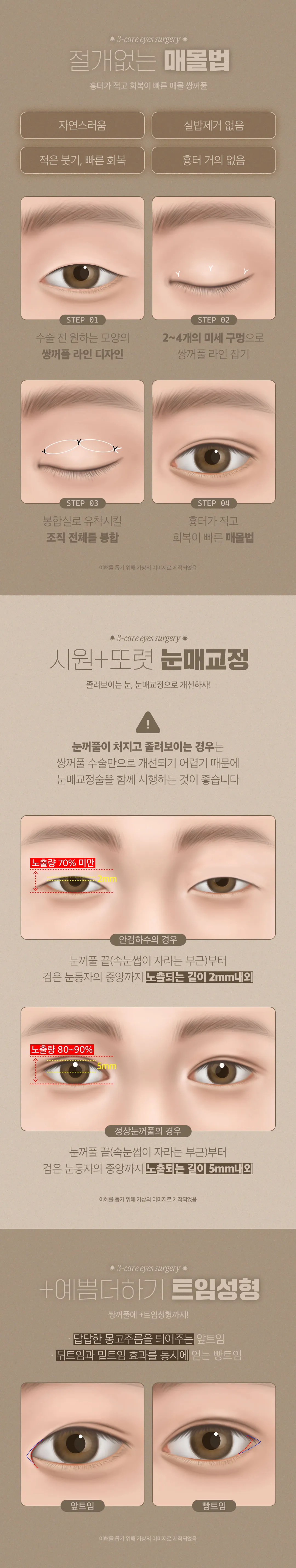 디엠성형외과 디엠 쓰리케어 눈성형 이벤트, 시술 상세 이미지