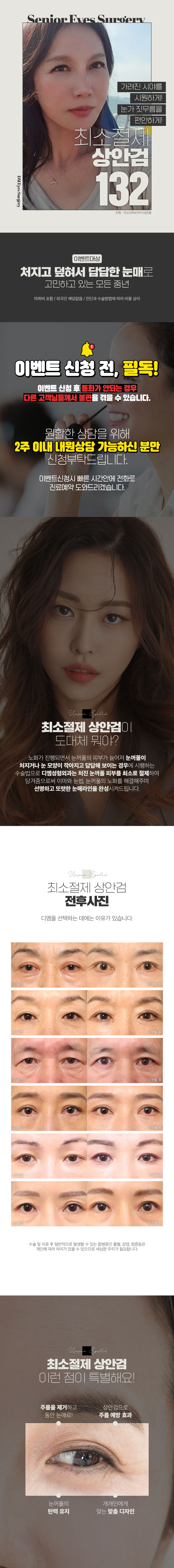 디엠성형외과 ♥최소절제 상안검♥ 이벤트, 시술 상세 이미지