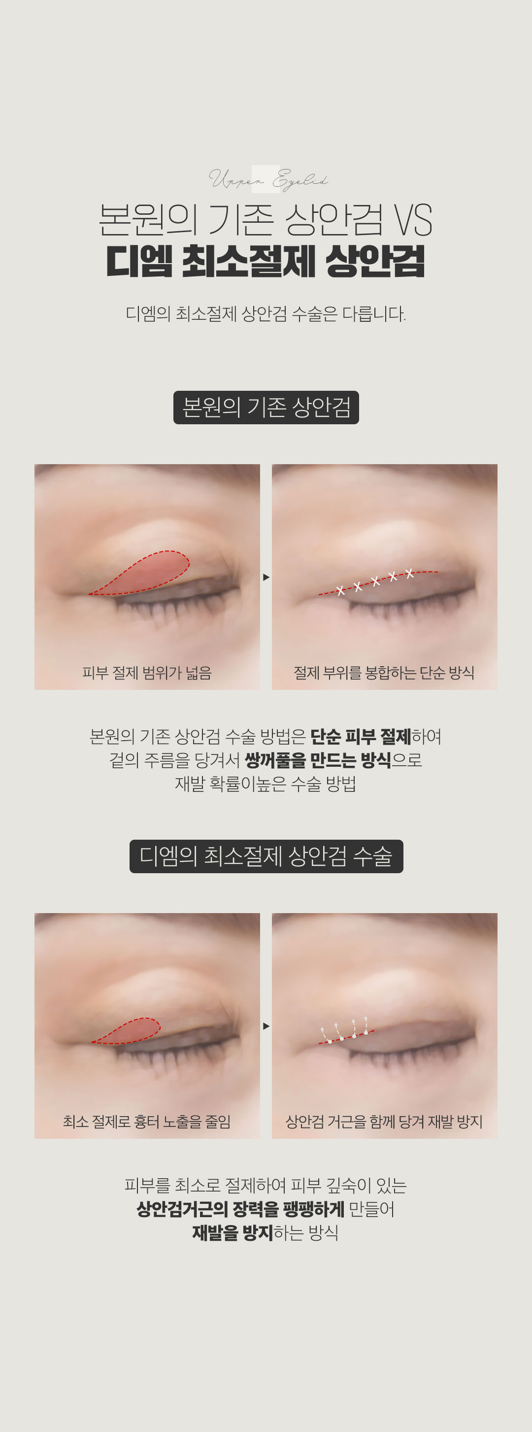 디엠성형외과 ♥최소절제 상안검♥ 이벤트, 시술 상세 이미지