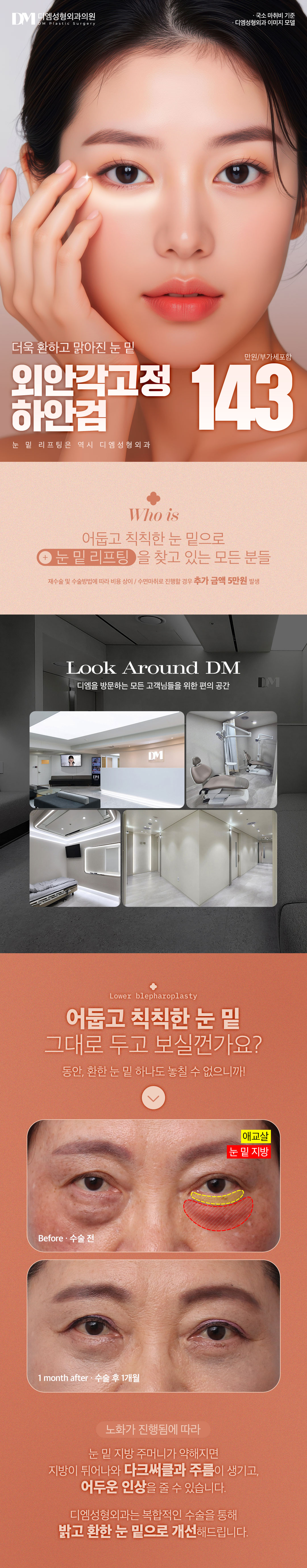 디엠성형외과 ♥디엠 외안각고정 하안검♥ 이벤트, 시술 상세 이미지