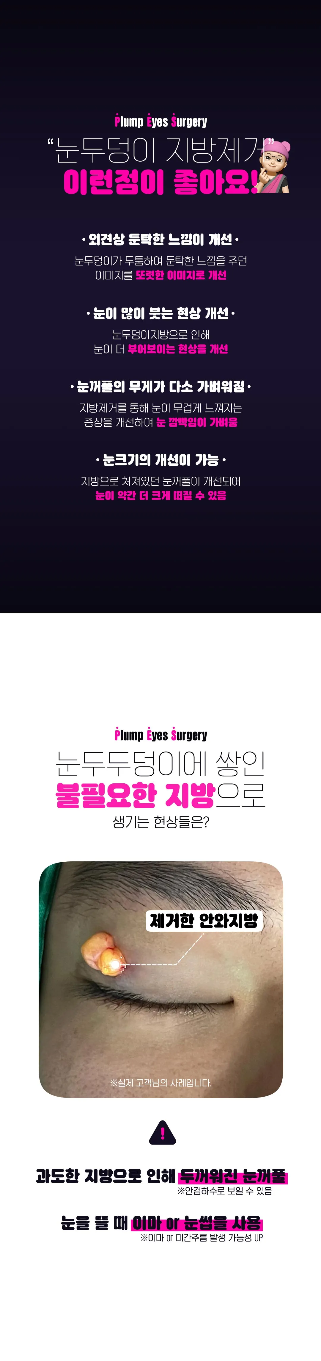 디엠성형외과 디엠 눈두덩이 지방제거 이벤트, 시술 상세 이미지