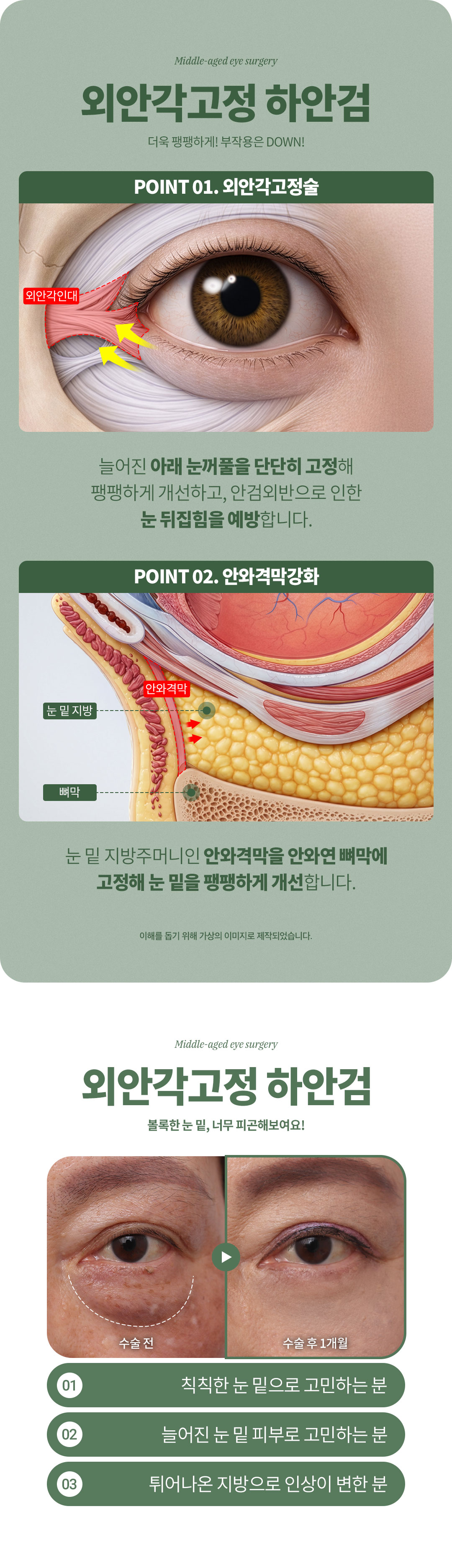 디엠성형외과 ♥디엠 중년눈성형♥ 이벤트, 시술 상세 이미지