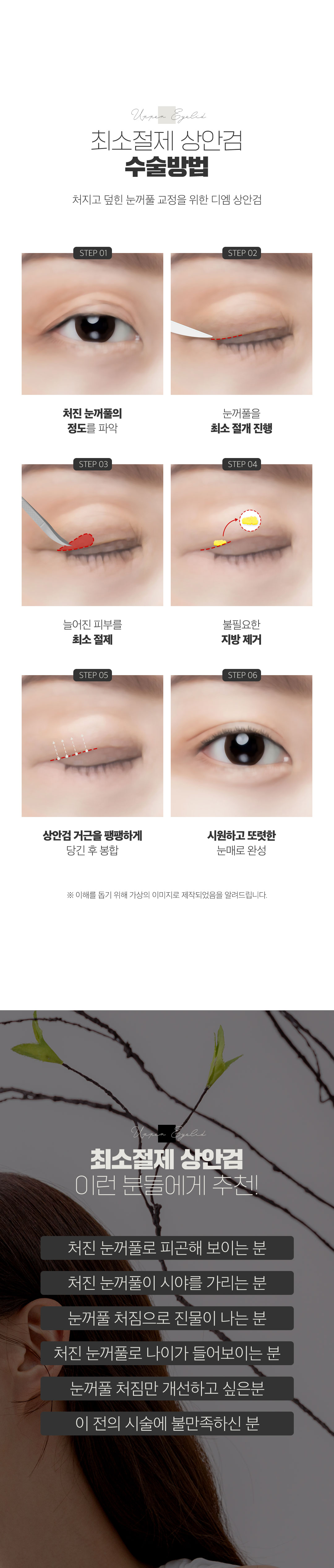 디엠성형외과 ♥최소절제 상안검♥ 이벤트, 시술 상세 이미지