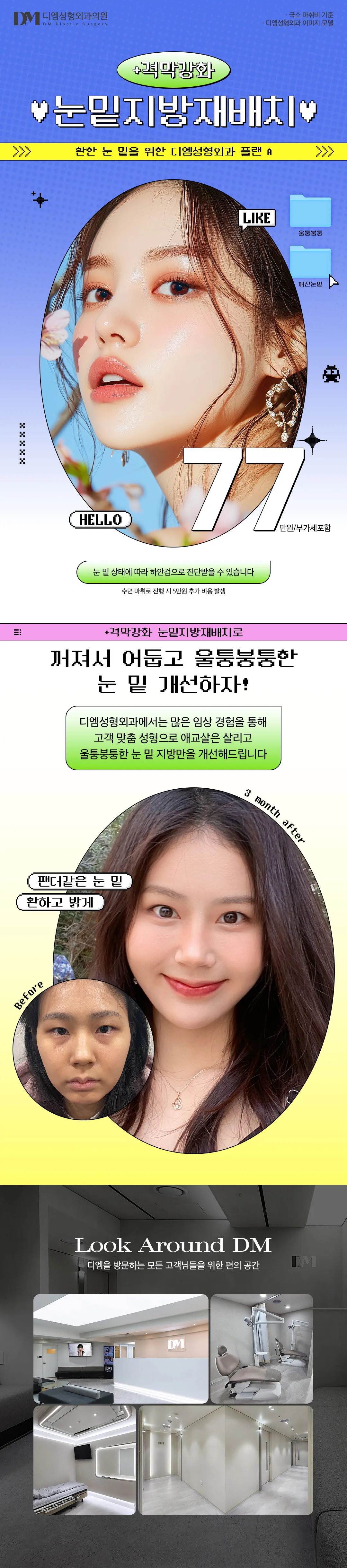 디엠성형외과 격막강화 눈밑지방재배치 이벤트, 시술 상세 이미지