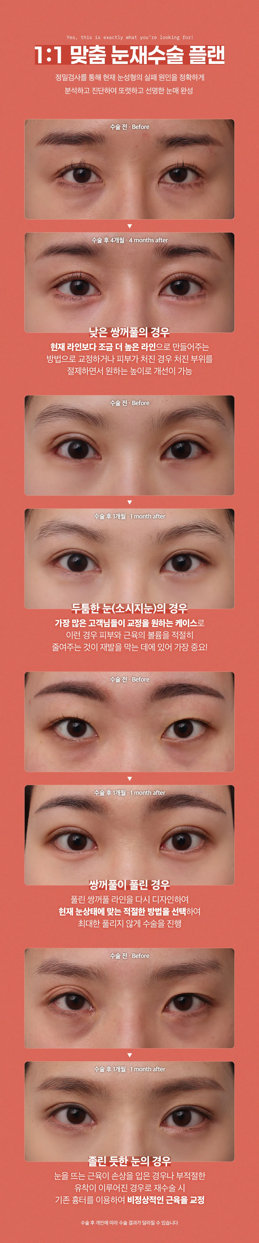 디엠성형외과 ❤디엠❤ 눈재수술 이벤트, 시술 상세 이미지