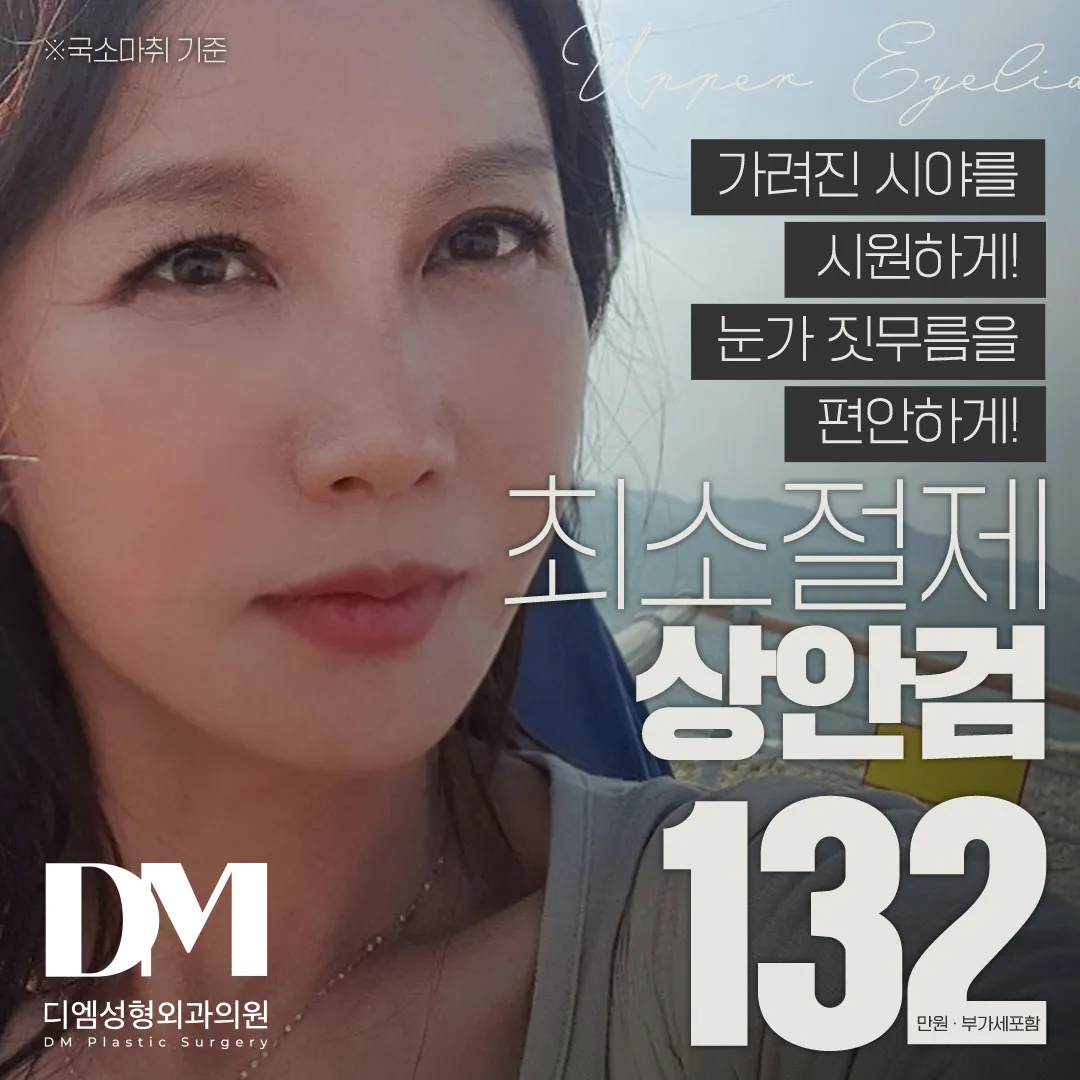♥最小切除上眼瞼♥