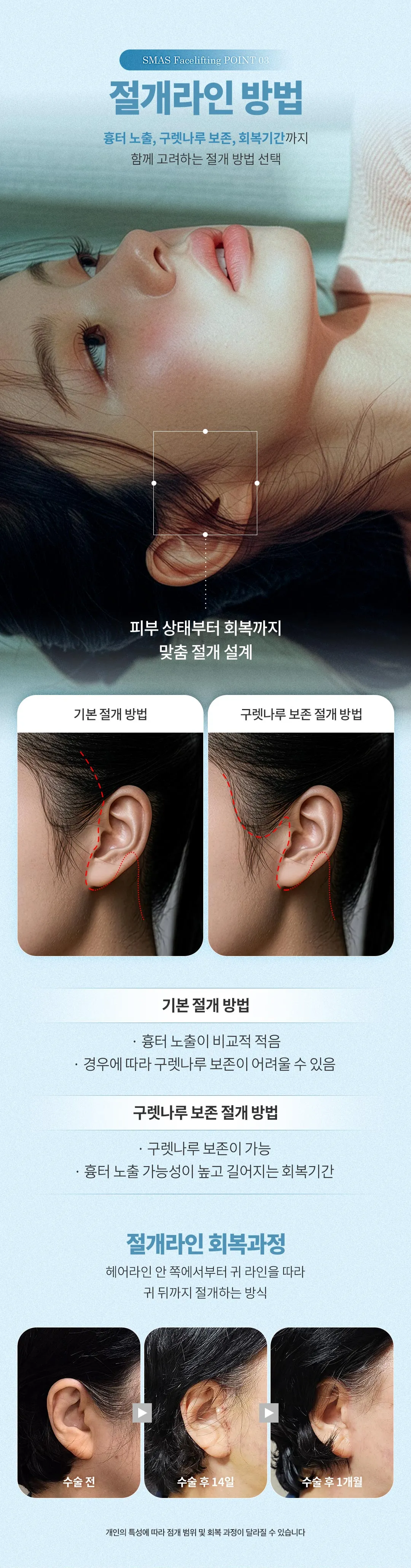 디엠성형외과 ♥디엠 스마스 안면거상 ♥ 이벤트, 시술 상세 이미지