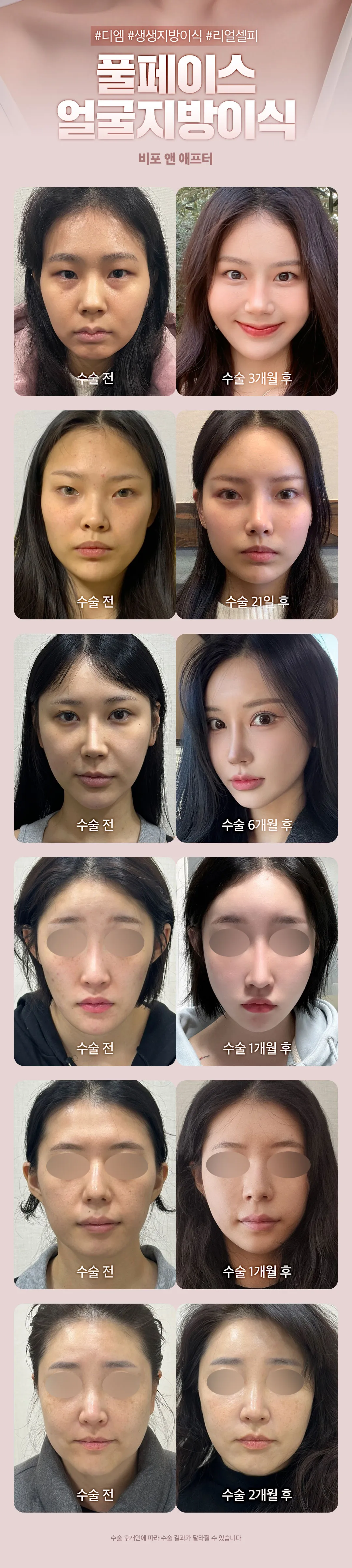 디엠성형외과 ★풀페이스 얼굴지방이식★ 이벤트, 시술 상세 이미지