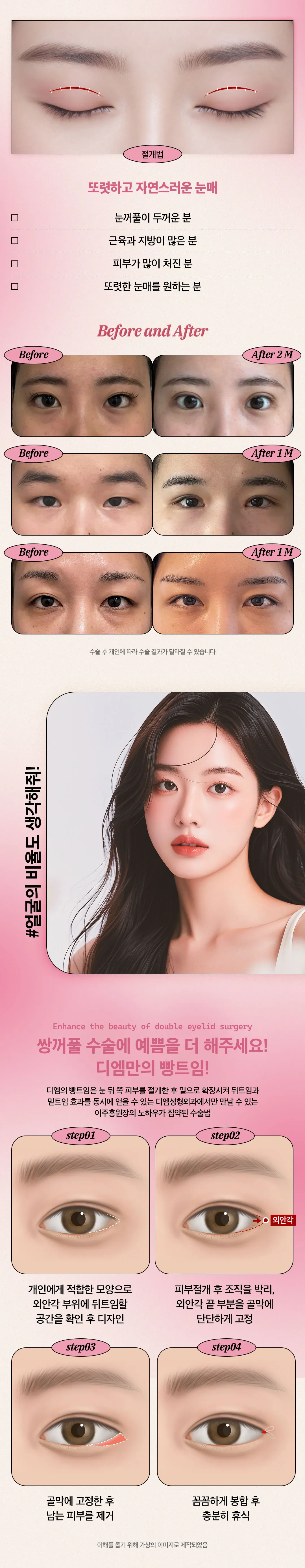 디엠성형외과 ♥디엠♥ 쌍꺼풀  이벤트, 시술 상세 이미지