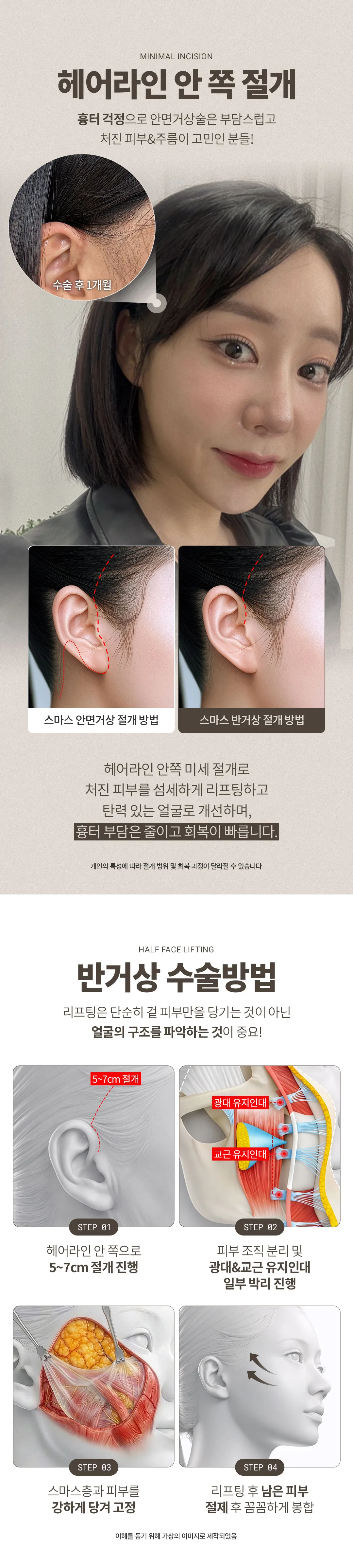 디엠성형외과 ♥디엠 스마스 반거상♥ 이벤트, 시술 상세 이미지