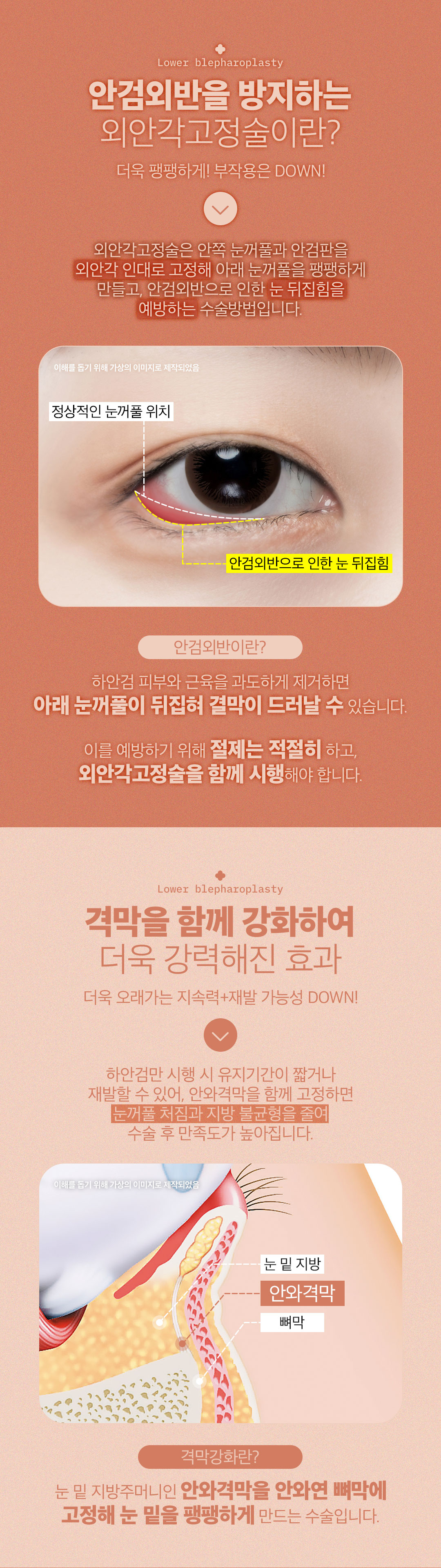 디엠성형외과 ♥디엠 외안각고정 하안검♥ 이벤트, 시술 상세 이미지