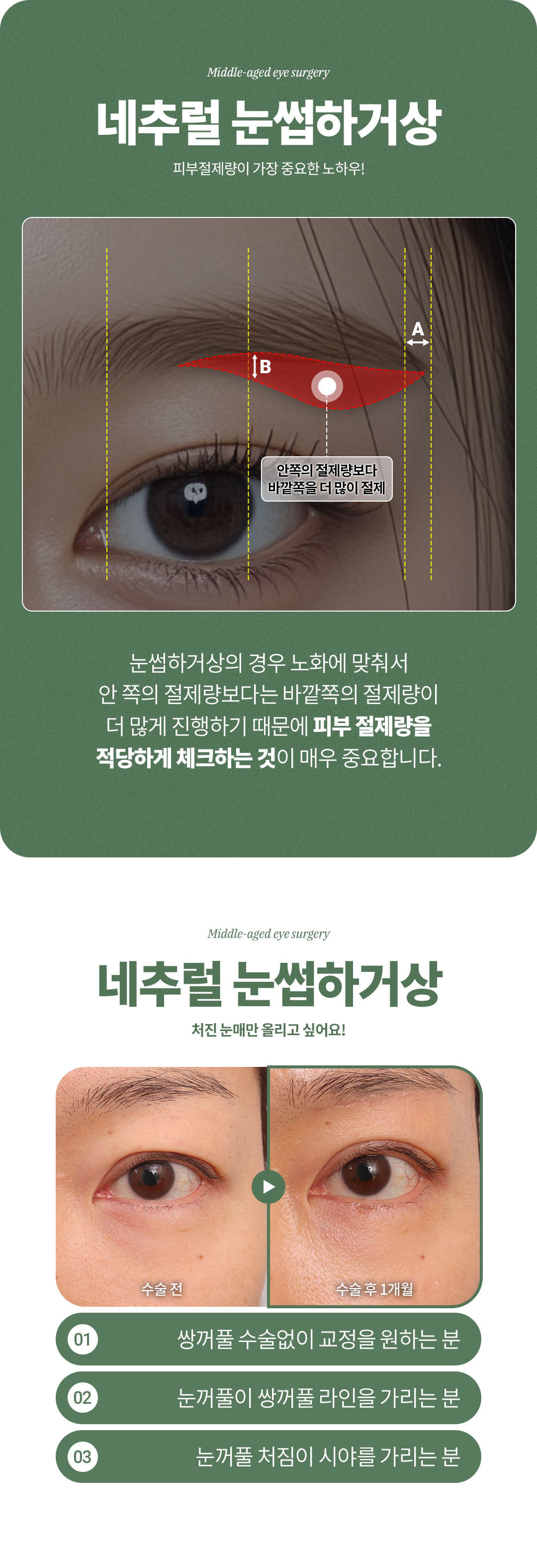 디엠성형외과 ♥디엠 중년눈성형♥ 이벤트, 시술 상세 이미지