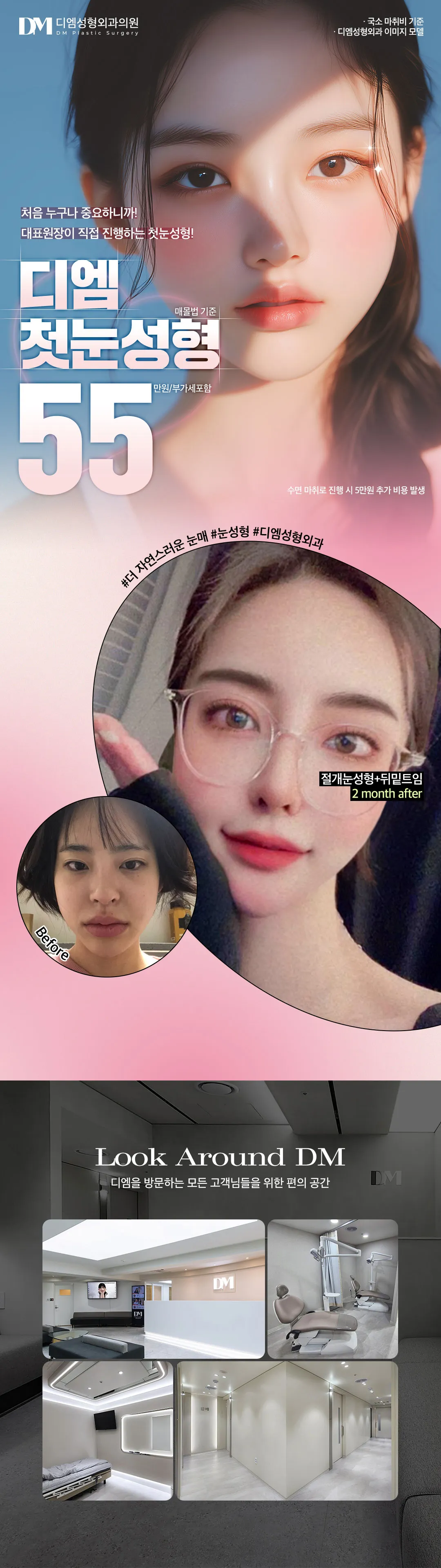 디엠성형외과 ♥디엠♥ 쌍꺼풀  이벤트, 시술 상세 이미지