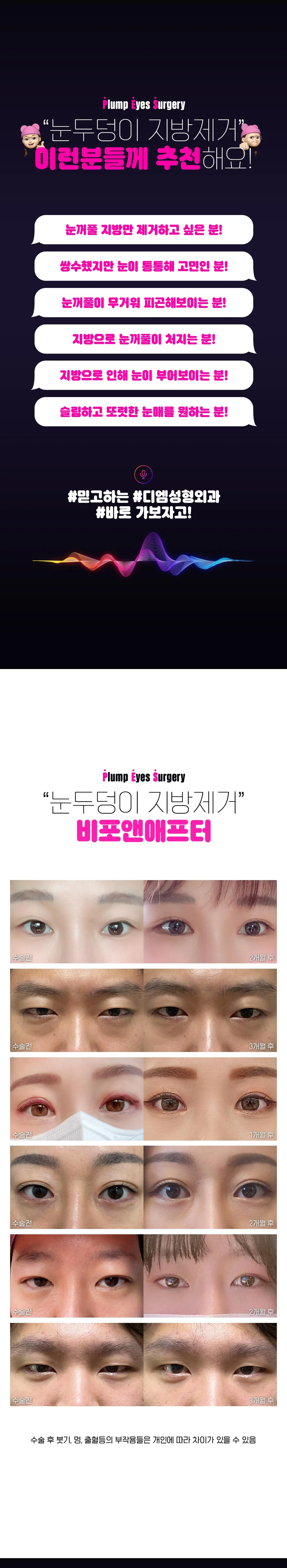 디엠성형외과 디엠 눈두덩이 지방제거 이벤트, 시술 상세 이미지
