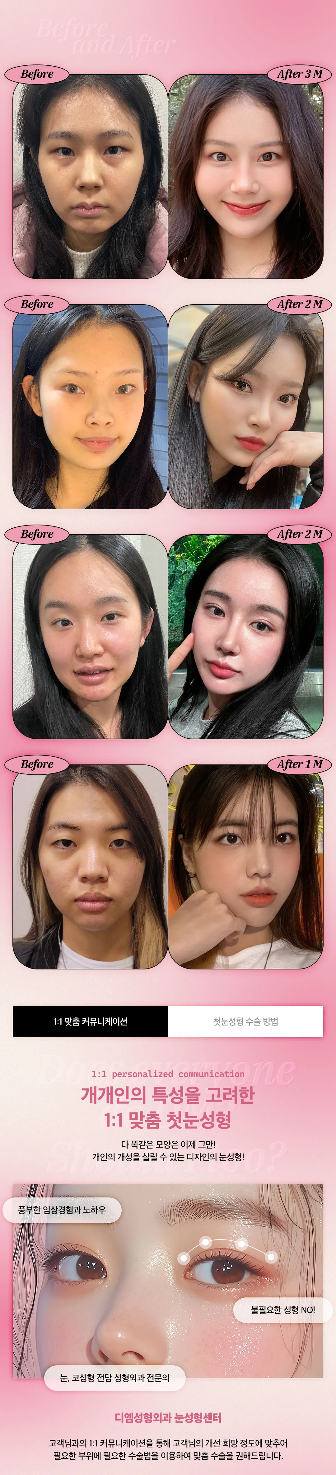 디엠성형외과 ♥디엠♥ 쌍꺼풀  이벤트, 시술 상세 이미지