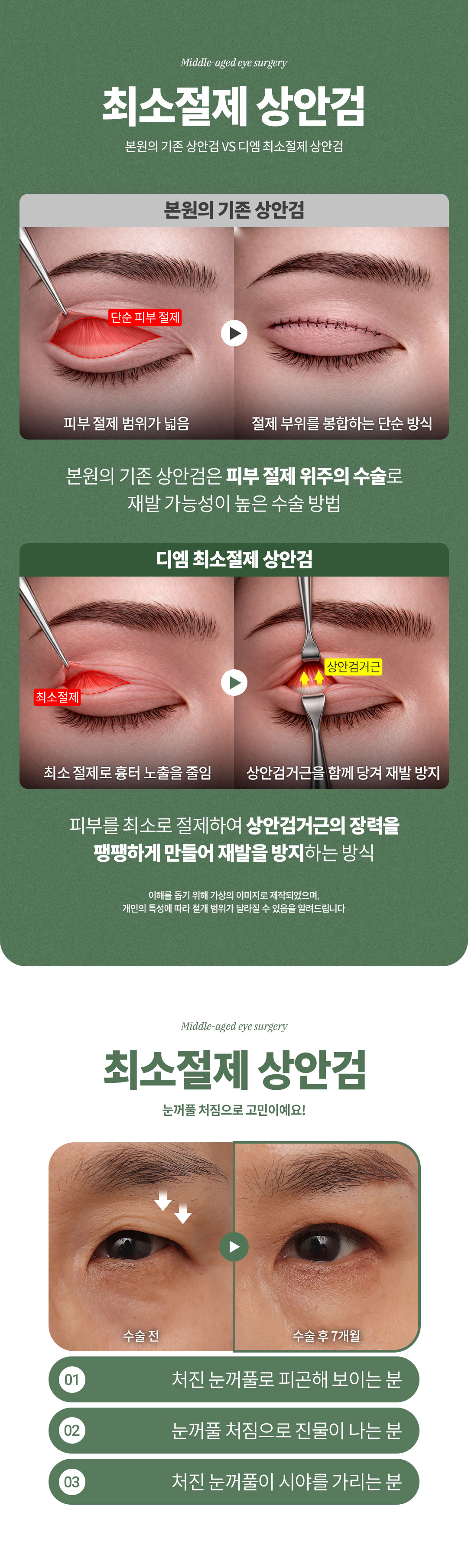 디엠성형외과 ♥디엠 중년눈성형♥ 이벤트, 시술 상세 이미지