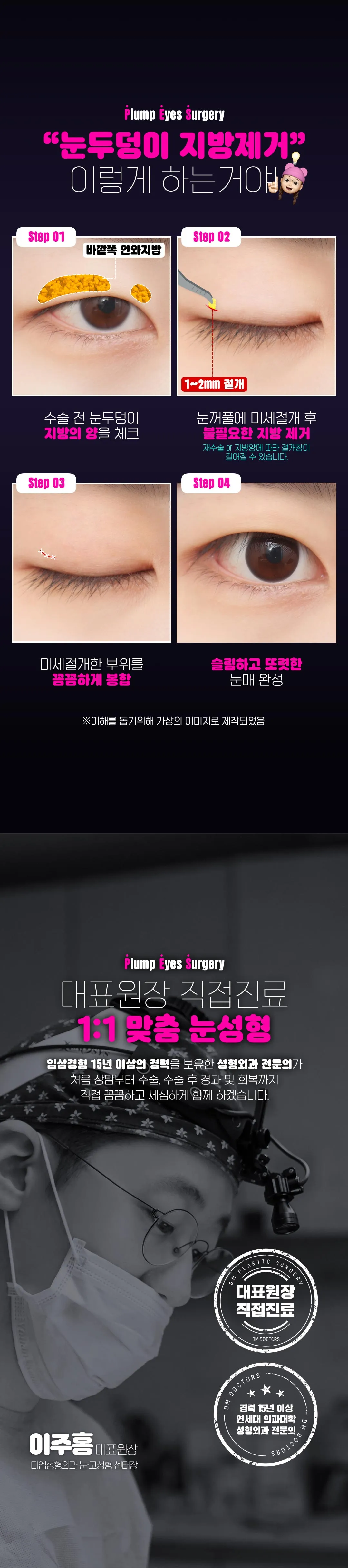 디엠성형외과 디엠 눈두덩이 지방제거 이벤트, 시술 상세 이미지