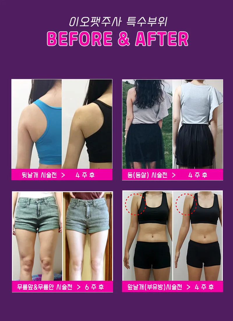 이오클리닉 특수부위 지방분해 이오팻주사 이벤트, 시술 상세 이미지