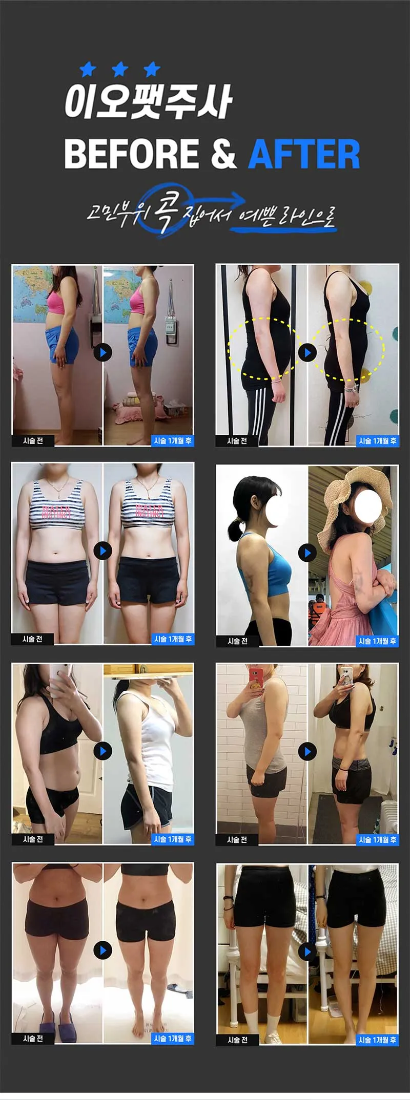 이오클리닉 스테로이드제로 지방분해 이오팻주사 이벤트, 시술 상세 이미지