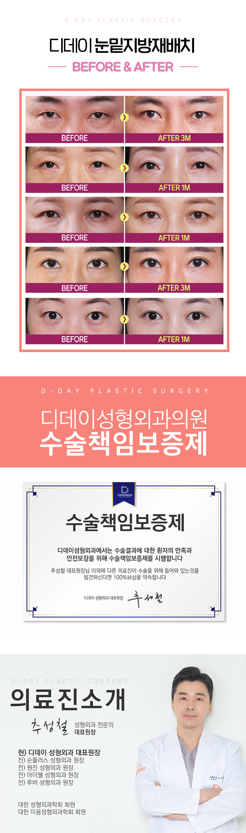 디데이성형외과의원 디데이💖눈밑지방재배치 이벤트, 시술 상세 이미지
