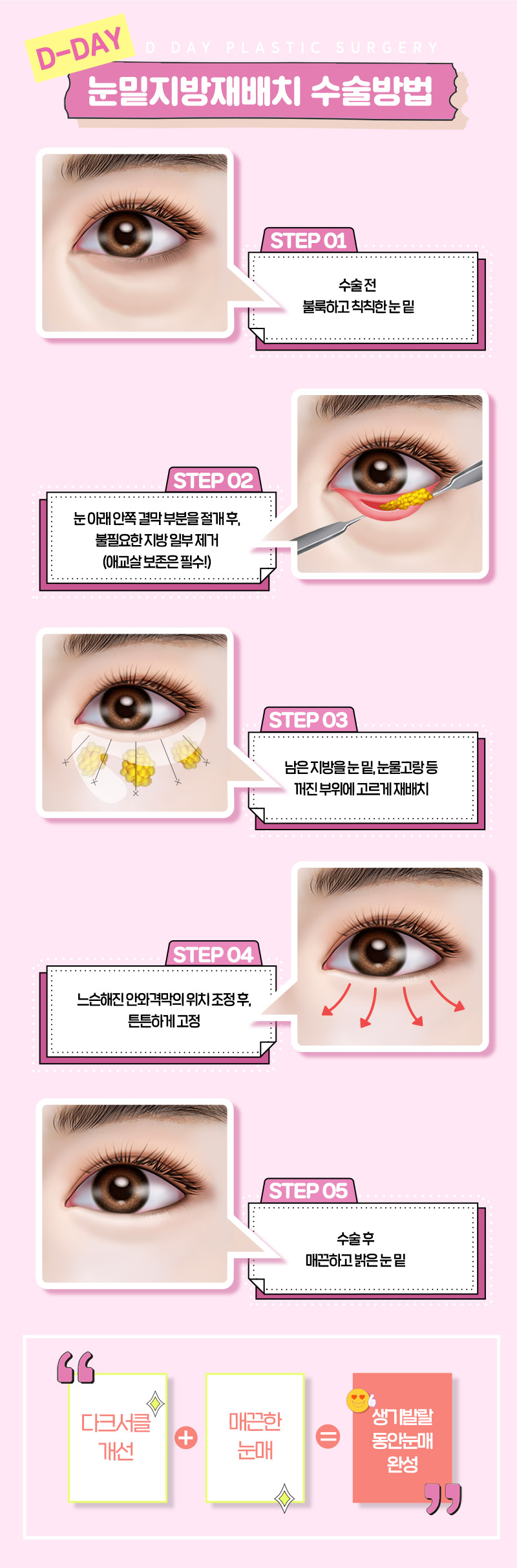 디데이성형외과의원 디데이💖눈밑지방재배치 이벤트, 시술 상세 이미지